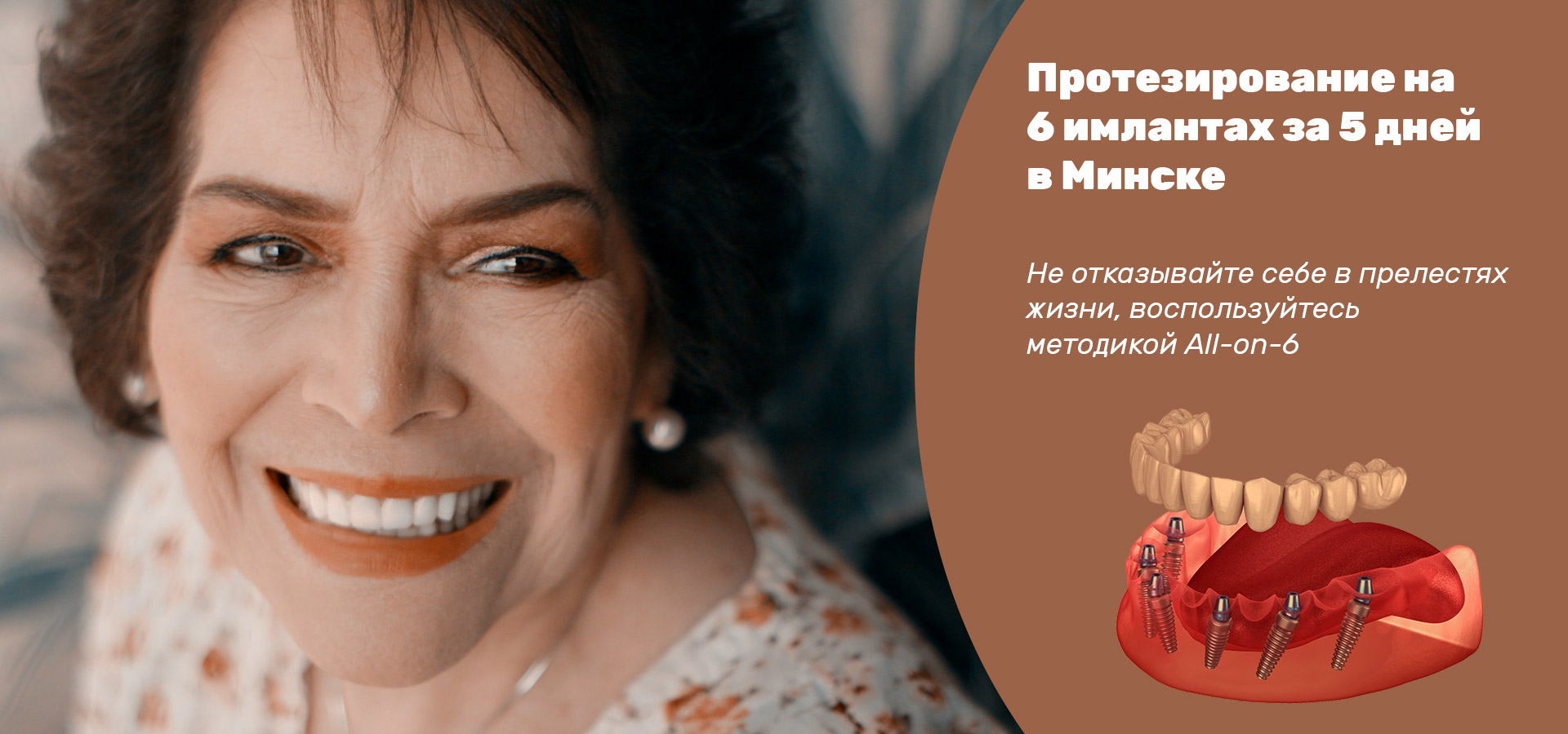 Имплантация All-on-6 в Минске