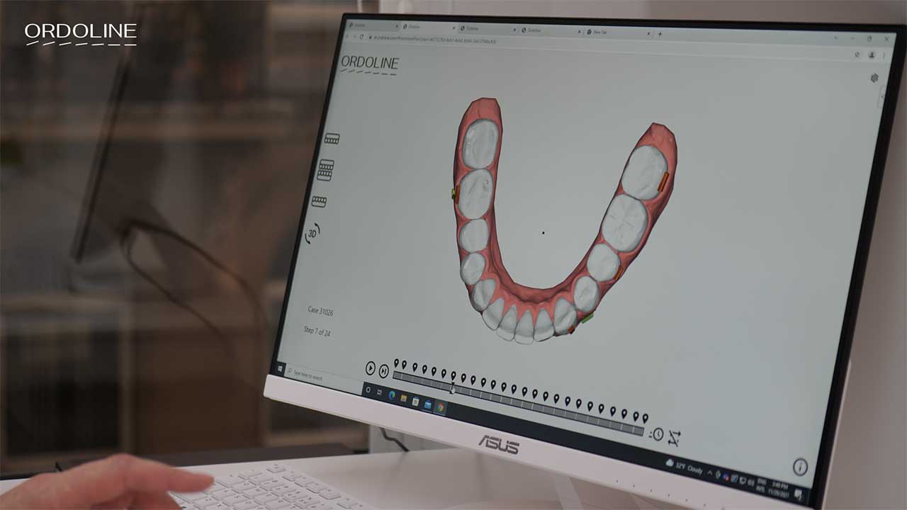 Элайнеры Ordoline изготавливаются по индивидуальным параметрам