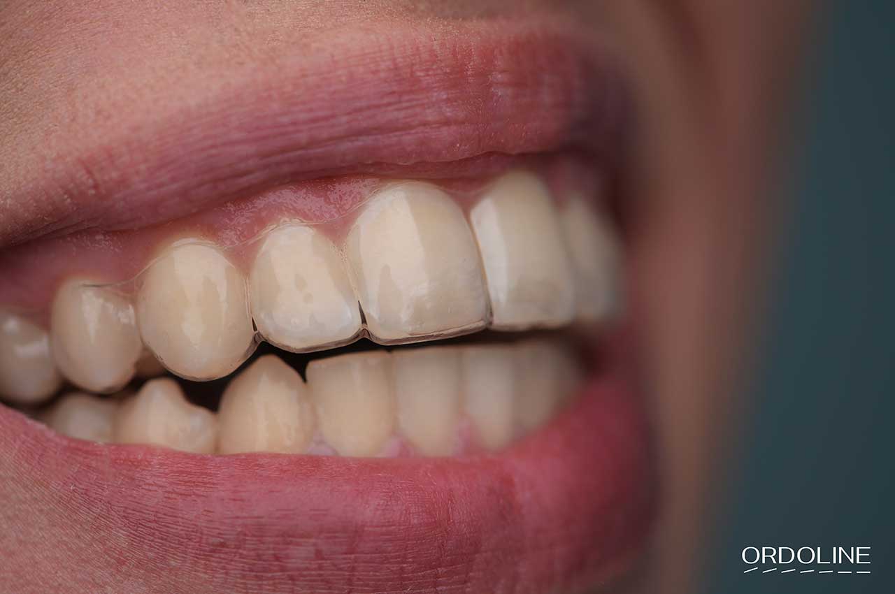 Элайнеры Ордолайн в Минске